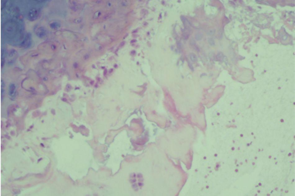 Figure 2.4. Knee joint sample in Group II (rat no.12) Moderate subchondral bone and cartilage damage